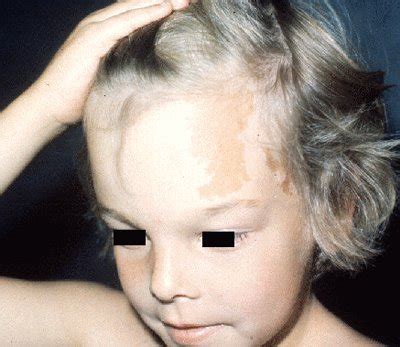 In this video series we'll run through a large number of genetic disorders. Albrights Syndrome