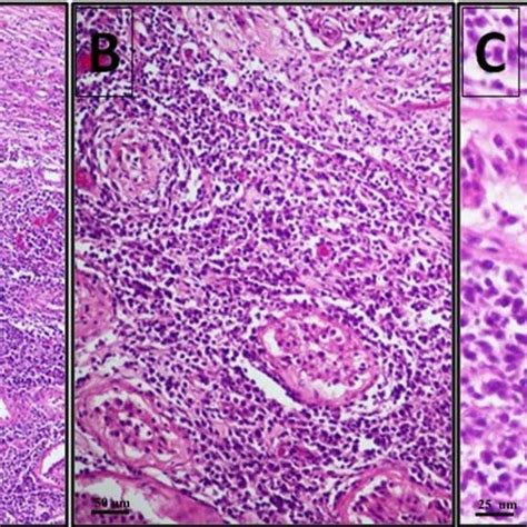 Testicular Invasion By Large B Cell Lymphoma At Different Download