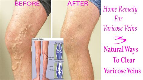 Home Remedy For Varicose Veins 3 Natural Ways To Clear Varicose Veins