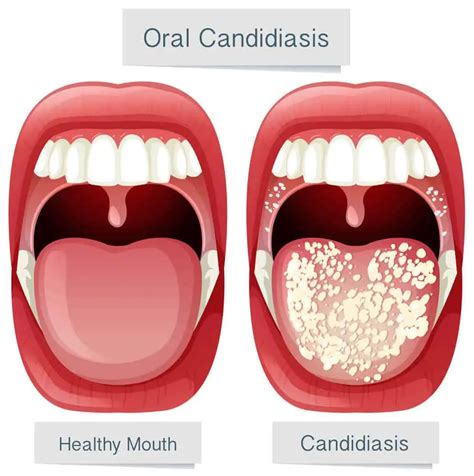 Candidiasis oral Cómo se contagia Causas síntomas y tratamientos