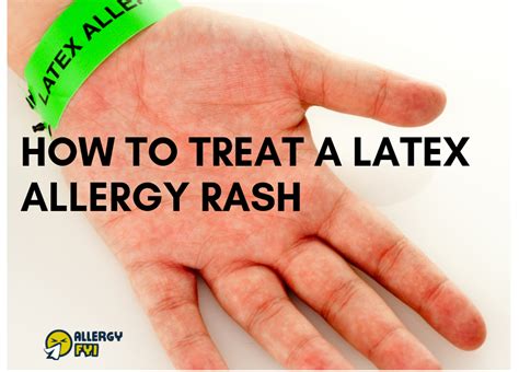 How To Know If You Have A Latex Allergy