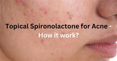 Topical Spironolactone For Acne How It Work