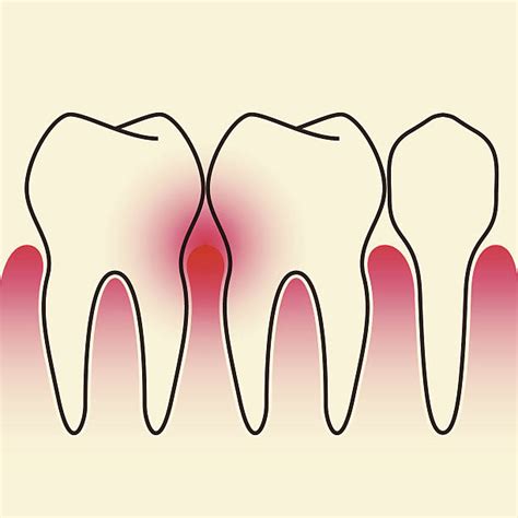 Periodontal Treatment Illustrations Royalty Free Vector Graphics