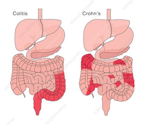 Crohn S Disease Ulcerative Colitis Comparison Stock Image C036