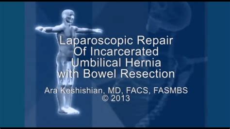 Laparoscopic Repair Of Incarcerated Umbilical Hernia With Bowel