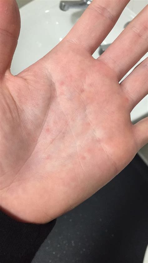 Red Spots On Palm Worried The Student Room