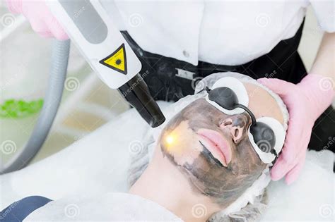 Close Up Carbon Face Peeling Procedure Laser Pulses Clean Skin Of The
