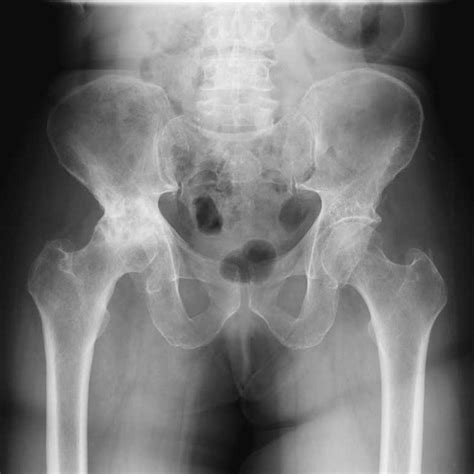 Radiograph Demonstrates Radiation Injury To The Hip Download