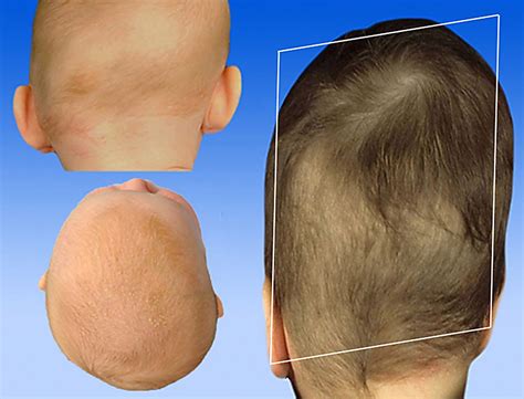 Occipital Plagiocephaly Unilateral Lambdoid Synostosis Versus