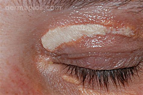 Yellow Eyelids Xanthelasma High Resolution Pictures And