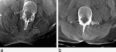 The Arrows Show Fatty Streaks In The Erector Spinae Musculature At L3