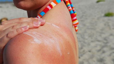 Texas Moms Viral Sunburn Hack Works But Its Not Magical Cure