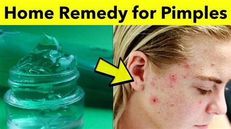 How To Get Rid Of Pimples On Forehead Overnight 5 Home Remedies For