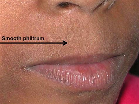 Philtrum of lip, causes of smooth philtrum, long or short philtrum