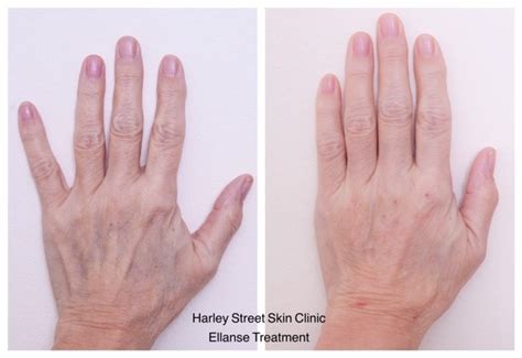 How Dry Hands Are A Sign Of Ageing And What You Can Do About It Uk