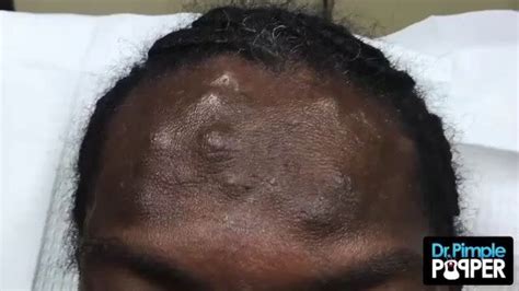 Dr Pimple Popper Watch This Huge Boil Explode All Over The Doctors
