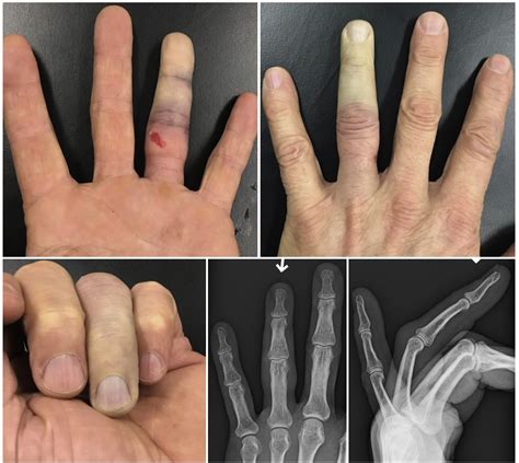 Closed Ring Avulsion Injury With Isolated Arterial Insufficiency