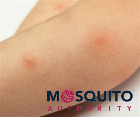 Can You Have An Allergic Reaction To Mosquito Bites