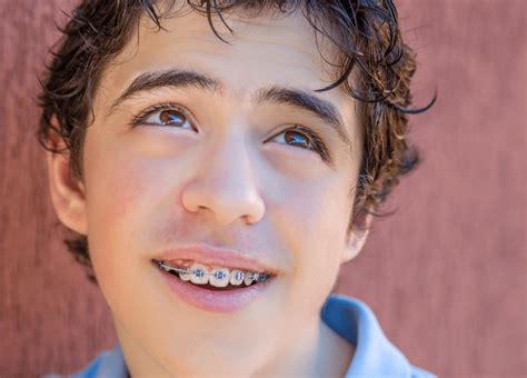 Guide To Getting Braces On Just Your Top Or Bottom Teeth Orthodontics