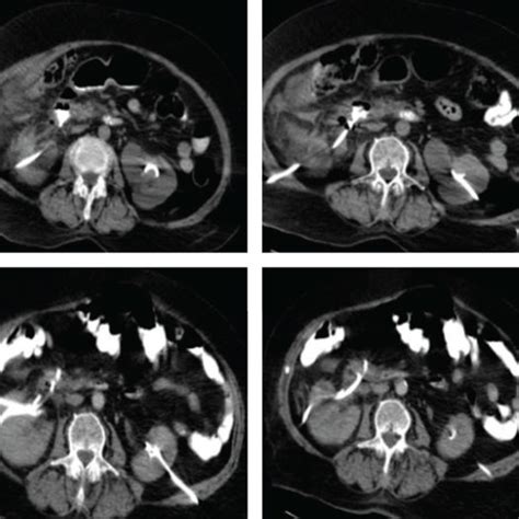 Oral And Intravenous Contrast Enhanced Abdominal Ct Images The Right
