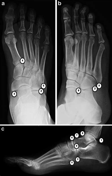 Accessory Ossicles Of The Foot Ap A Oblique B And Open I