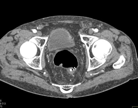 Bladder Cancer Obstructs The Left Ureter Genitourinary Case Studies