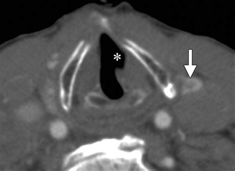 Unilateral Vocal Cord Paralysis A Review Of CT Findings Mediastinal