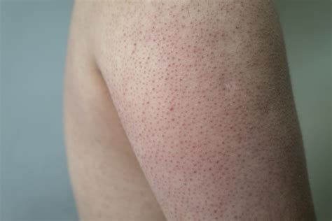 What Is Kerastosis Pilaris And How To Get Rid Of This Common Skin Condition