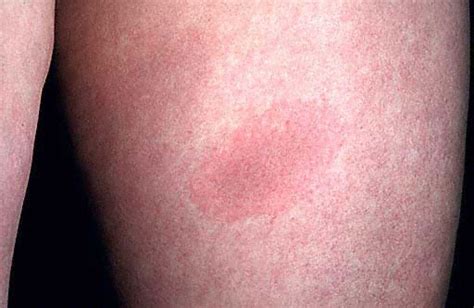 The Characteristic Bullseye Rash For Lyme Disease Innatoss