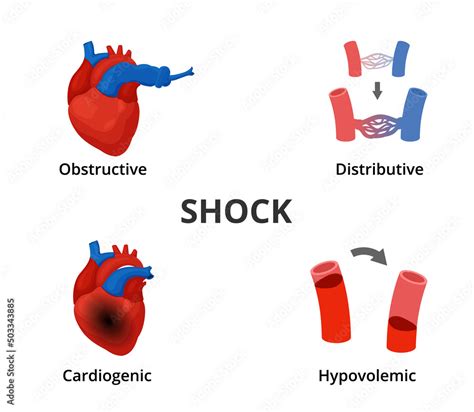 4 Types Of Shock Diagram Medical Emergency Infographics Stock Vector