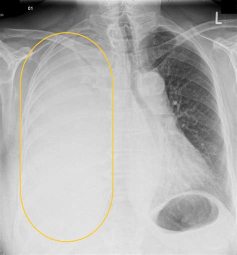 Poems Syndrome Chest X Ray Wikidoc