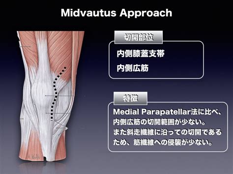 Midvastus Approachとは │ 整形外科のいろいろ