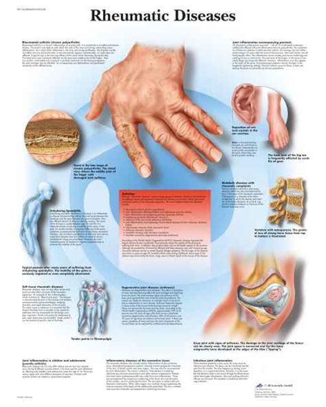 Joint Anatomical Charts Joint Arthritis Anatomy Posters