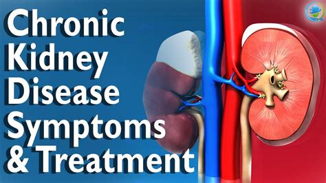 What Are The Symptoms And Treatment Of Chronic Kidney Disease Kidney