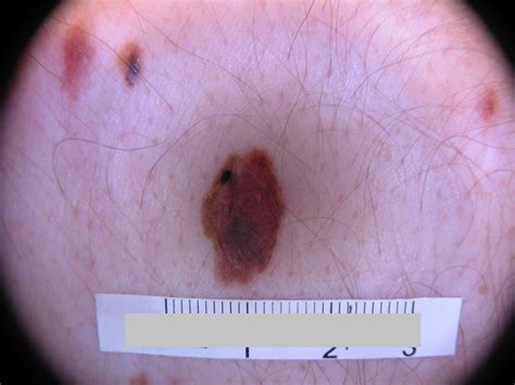 Acd A Z Of Skin Melanoma