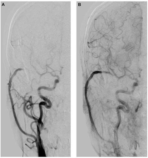 A Follow Up Right Carotid Angiogram Performed 1 Year After The