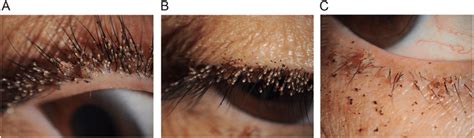 Photos Of Her Right Eye Shows Multiple Nits And Lice On Eyelashes Of