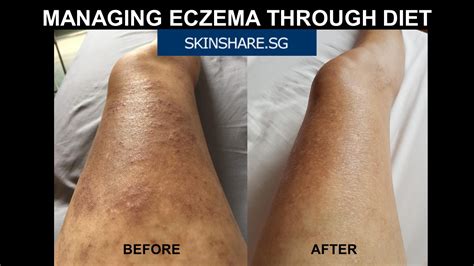 What Is Eczema Diet Skinshare Singapore