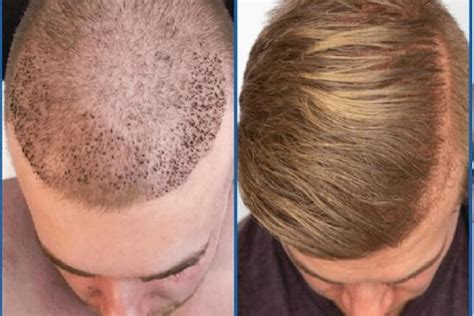 Hair Transplant Cost Turkey Implants Istanbul Capilclinic ️