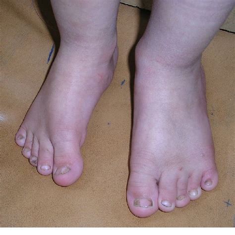 Bilateral Overriding Of The 2nd Toe Over The 3rd Toe And Syndactyly