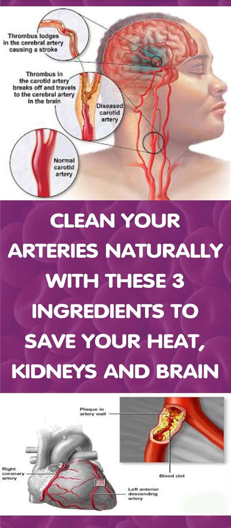Fine Article About How To Clean Your Arteries Naturally With These 3