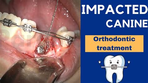 Impacted Canine Exposure Treatment With Orthodontics And Braces Step