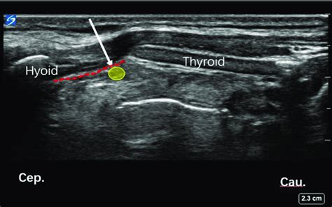 Ultrasound Image Of Isln Block A Hyoid Bone And Thyroid Cartilage