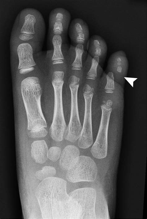 Post Traumatic Toe Deformity In A Child The Bmj