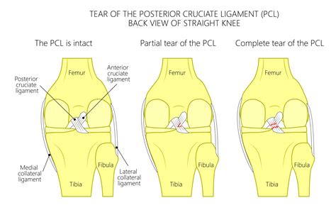 What Is The Difference Between An Acl Sprain And Tear Athletico