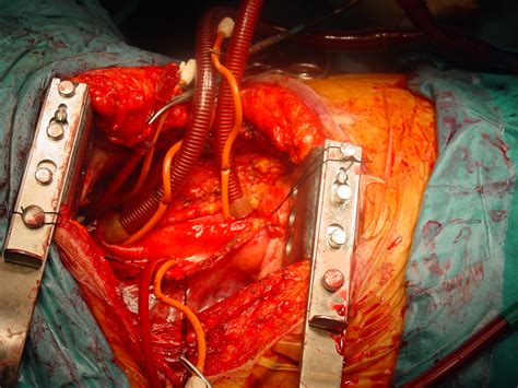 Skeet ulrich gives a 'rare look' inside his open heart surgery nearly 40 years ago with graphic photo. ISMICS - Beating Heart Mitral Valve Replasment In Redo ...