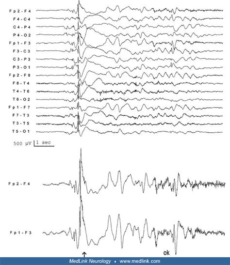 Myoclonic Epilepsy In Infancy Medlink Neurology
