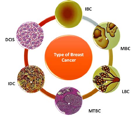 Demonstration Of Major Types Of Breast Cancer Download Scientific Diagram