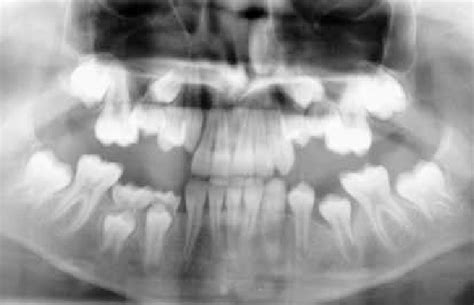 Panoramic Radiograph Showing Submerged Maxillary Second Primary Molars Download Scientific