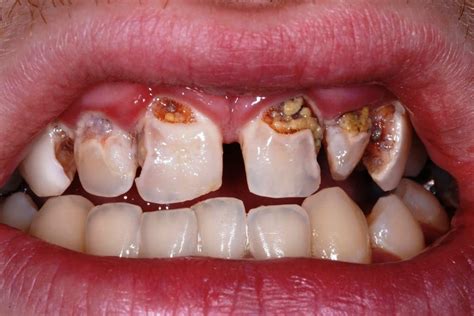 Tooth Decay Cavities Also Known As Dental Caries